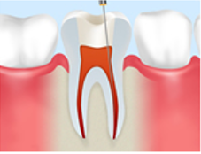根管の拡大・清掃
