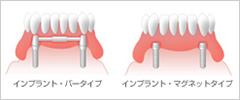 全ての歯を失った場合