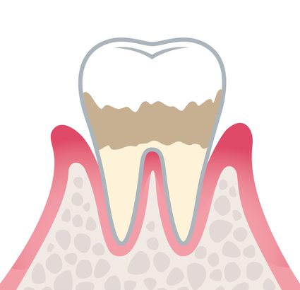 軽度歯周炎