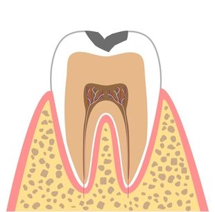 Ｃ１：痛みを感じないむし歯