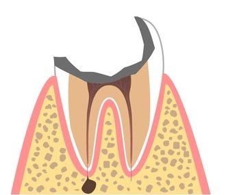 Ｃ４：むし歯の末期状態
