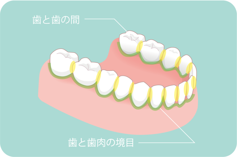 歯と歯の間・歯と歯肉の境目