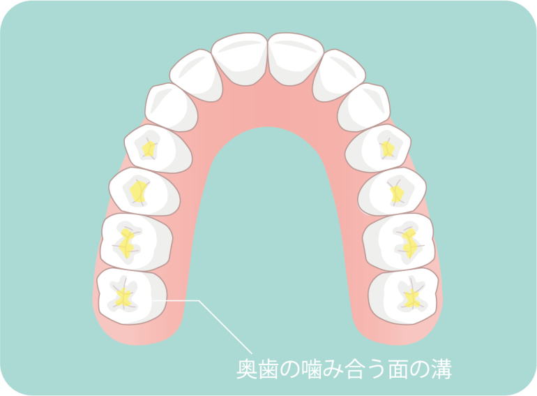 奥歯の噛み合う面の溝