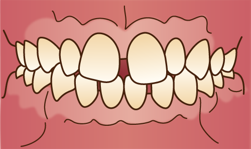 正中離開 ○上顎中切歯